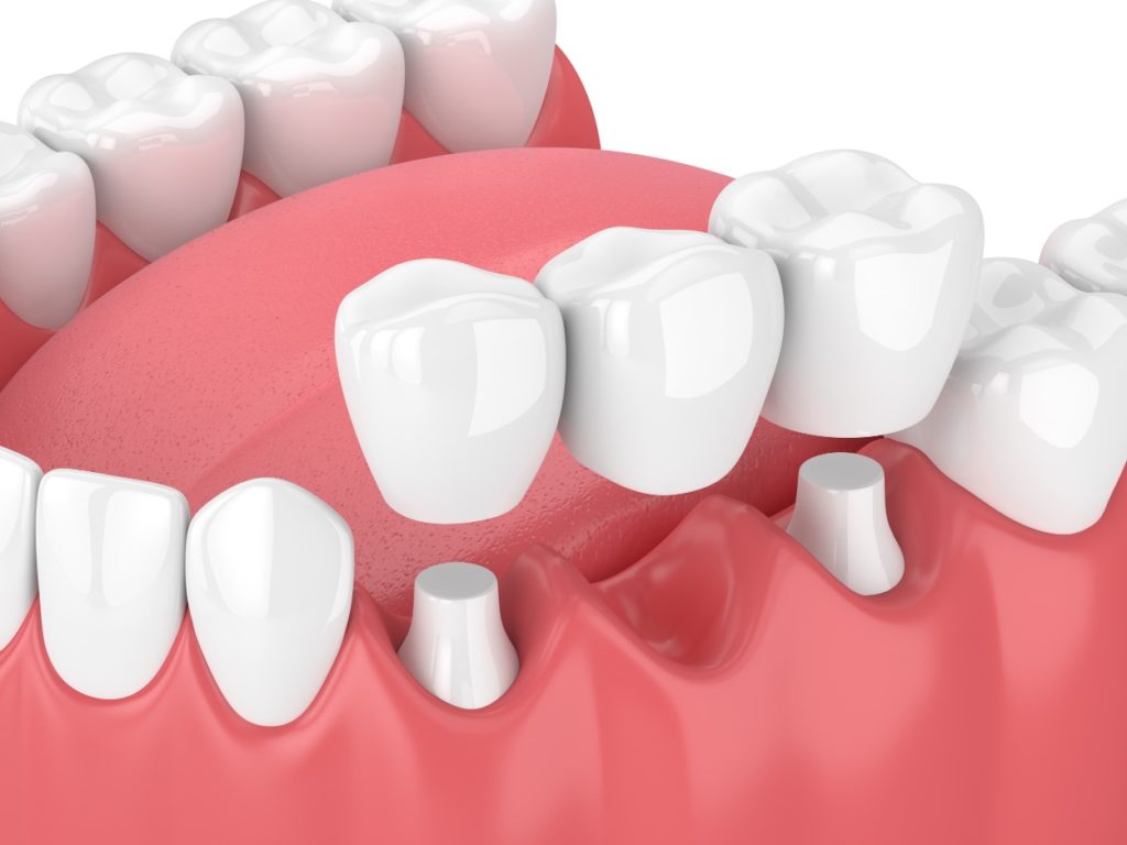 dental bridge treatment in pune 