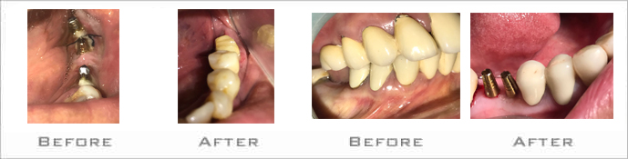 Dental implant treatment in Bibvewadi, Salisbury Park, pune