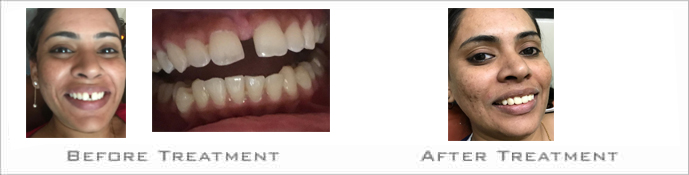 Dental implant treatment in Bibvewadi, Salisbury Park, pune