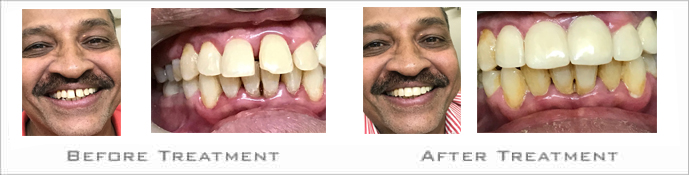 Dental implant clinics in Bibvewadi, Salisbury Park, pune