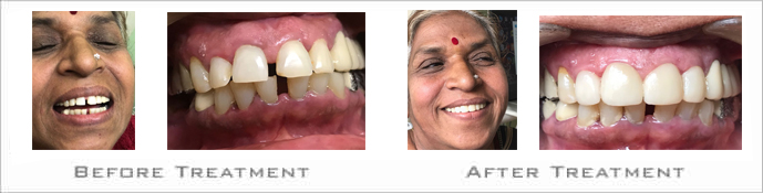 Orthodontic Treatment Clinics in Bibvewadi, Salisbury Park, Pune