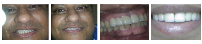 Orthodontic Treatment services in Bibvewadi, Salisbury Park, Pune