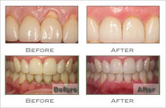 Teeth whitening treatment and services in Pune