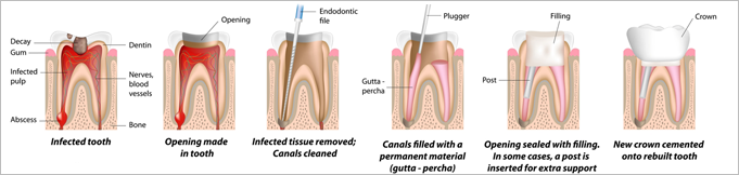Root canal Specialist in Pune