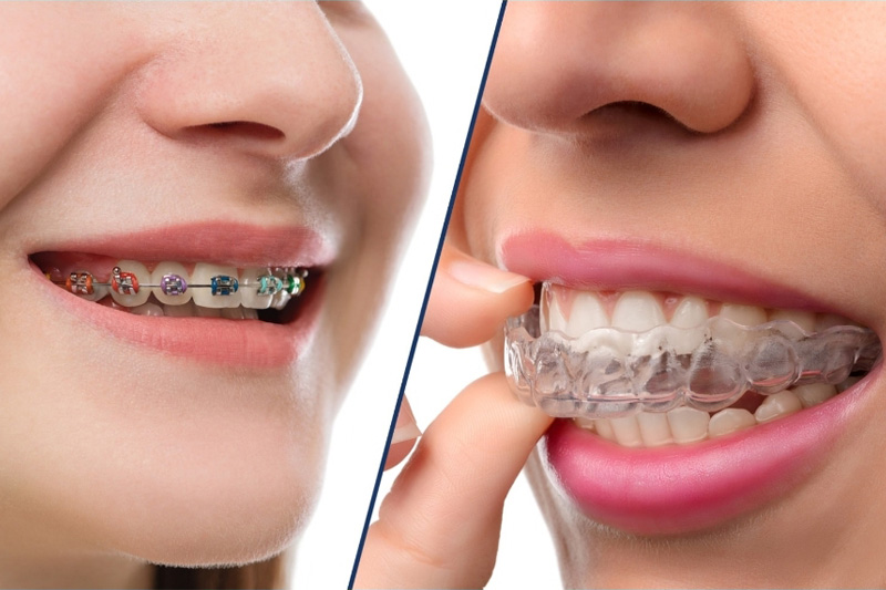 Orthodontic Treatment services in Bibvewadi, Salisbury Park, Pune