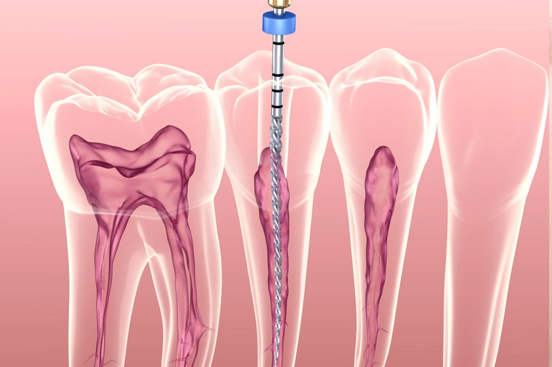 root canal treatment in Bibvewadi, Salisbury Park, pune