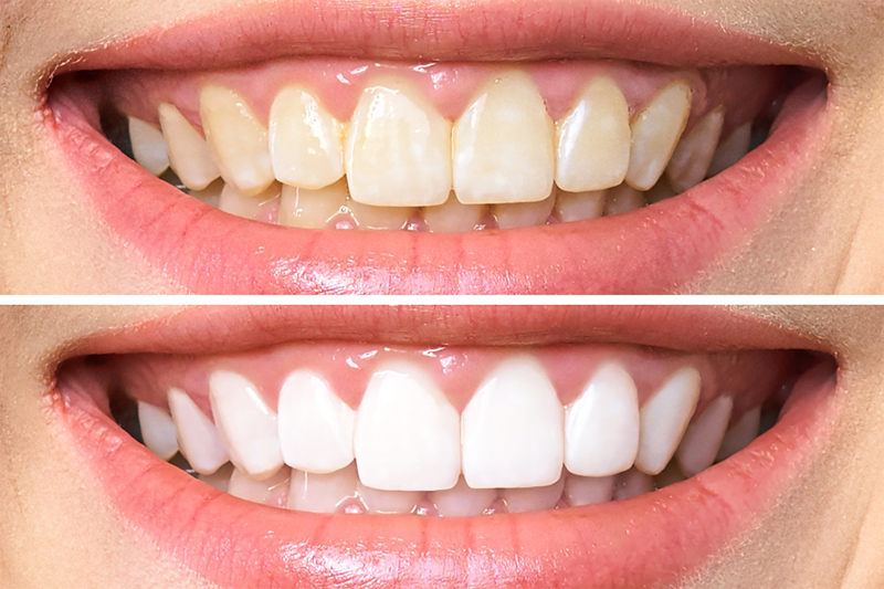 Teeth whitening services in Pune